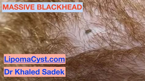 Maasive Blackhead Dr Khaled Sadek Youtube