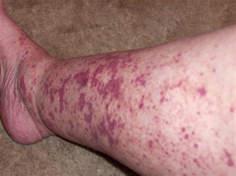 Photos Of Cryoglobulinemia Rash And Necrosis Viewer Discretion Is