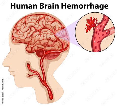 What Is Brain Hemorrhage Causes Andtreatment