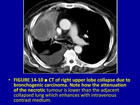 Pulmonary Lobar Collapse Essential Considerations 14 Dr Muhammad Bin