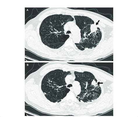 Findings Of Chest Ct A Image From Chest Ct Shows A Mass Arrow In