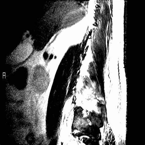 Another View Of Lumbar Spine Mri Showing Paraspinal Abscess Download