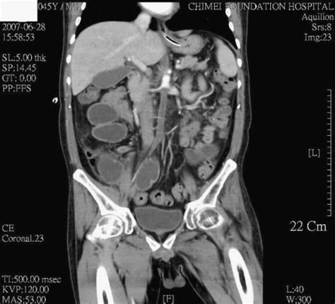 Coronal Reconstruction Of Contrast Enhanced CT Scan Of Open I
