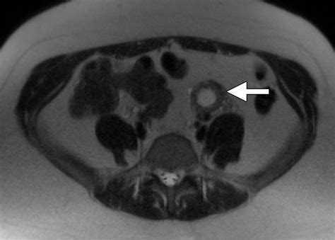 Mr Imaging Findings Of Ectopic Pregnancy A Pictorial Review