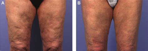 A This 66 Year Old Woman Presented For Treatment Of Her Legs B