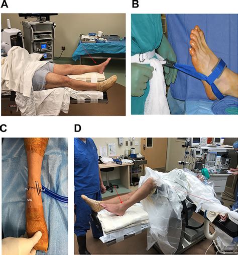 Operative Approaches To Ankle And Hindfoot Arthroscopy Dominic S