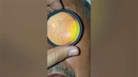 Weiss Ring By Smartphone Fundus Photography Youtube