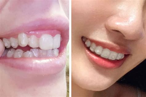 Invisalign Buttons Ultimate Guide For Effective Treatment Beautykylie