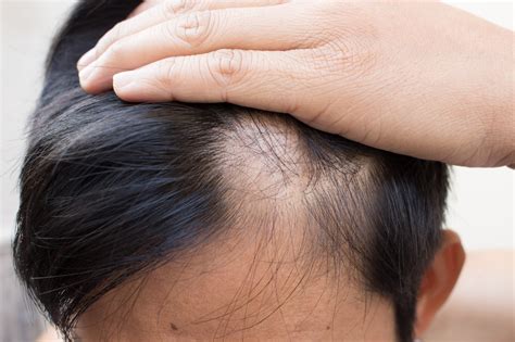 Types Of Alopecia Areata Alopecia Areata Hair Loss Treatment Srs Hair Clinic