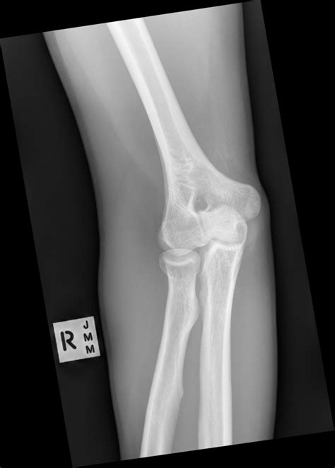 Emrad Radiologic Approach To The Pediatric Traumatic Elbow X Ray