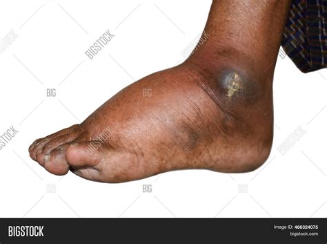 Pitting Edema Lower Image And Photo Free Trial Bigstock