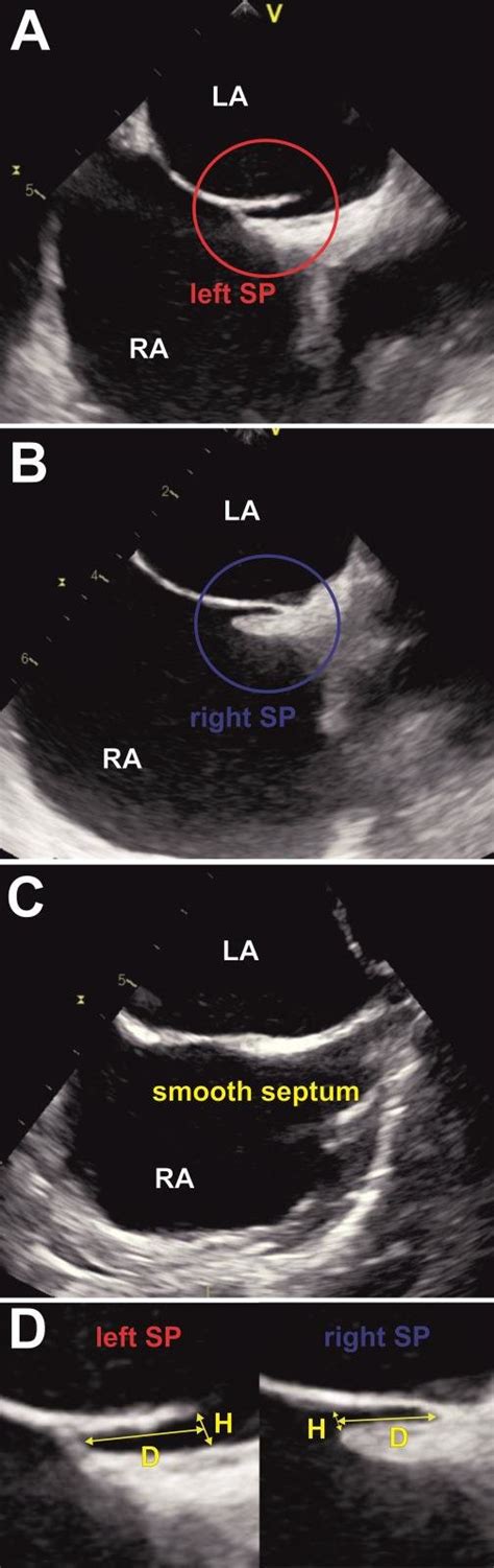 Mid Esophageal Bicaval View Of Interatrial Septum In Two Dimensional