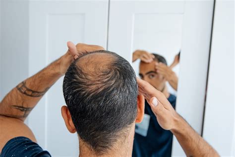 The Basics Of Balding Causes Signs And Treatments Banner
