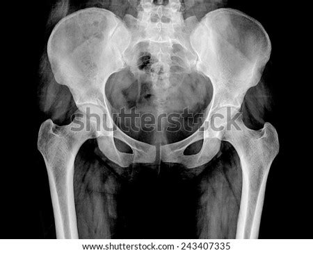 An inward curve in the lower back (lumbar area: Xray Pelvis Spinal Column Woman Stock Photo (Royalty Free) 243407335 - Shutterstock