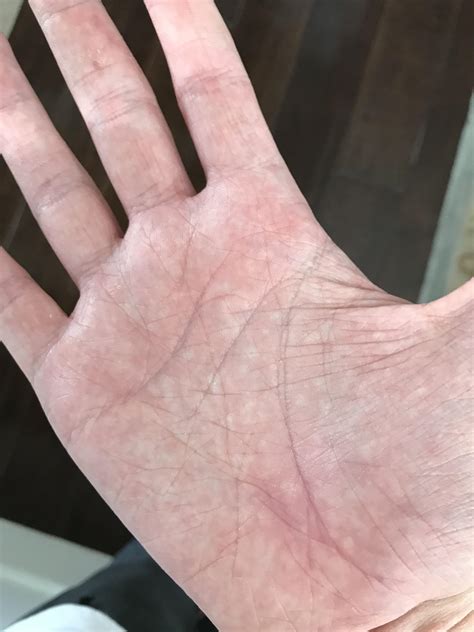 Why Do I Have A Red Rash On My Hand