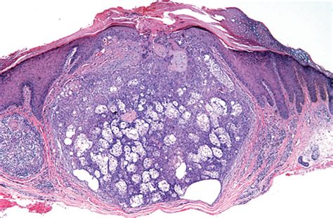 A Rapidly Growing Nodule And Dome Shaped Yellow Papules On The Face