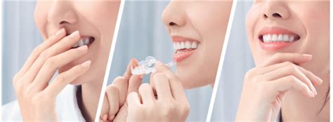 Invisible Braces Invisalign Centre Fresh Breath Dental Clinic Kalyan