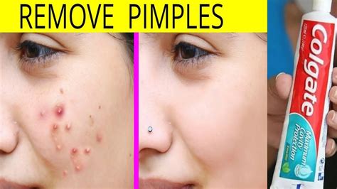 How To Remove Pimples Overnight With Toothpaste Acne Treatment