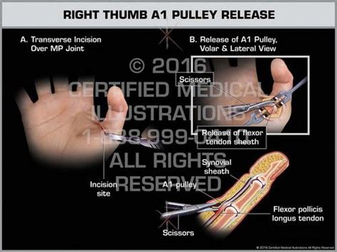 Right Thumb A1 Pulley Release Trigger Thumb Pulley Health Advice