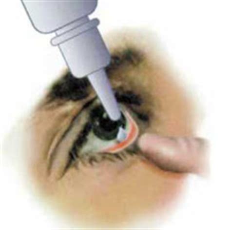 Most people use more eye drops than necessary, and fall short of using good techniques. Nursing Procedures: Administering Eye Drops
