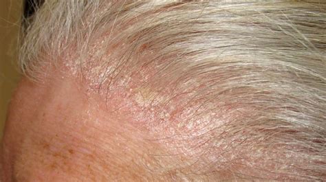 How To Get Rid Of Dry Scalp Psoriasis