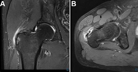 Gluteal Tendinopathy Causes Symptoms Diagnosis And Treatment Reliefly