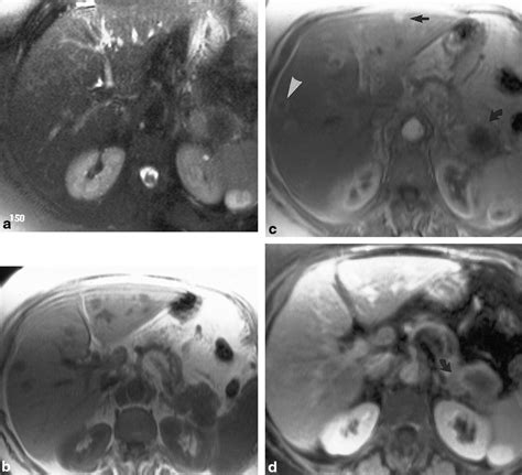 Liver Metastases From Pancreatic Adenocarcinoma Mr Imaging