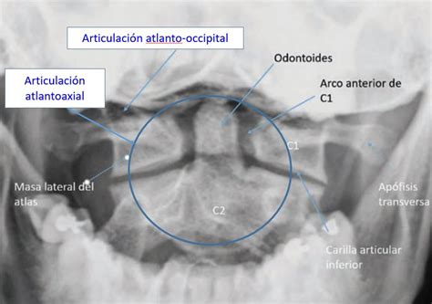 Articulación Atlantoaxial Dolopedia