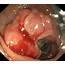 Colon Cancer Endoscope View  Stock Image C041/5864 Science Photo