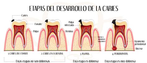 La caries dental Síntomas causas prevención y tratamientos