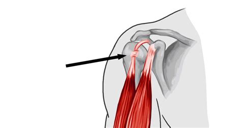 Biceps Tendonitis Tendinopathy In The Shoulder Symptoms And Treatment