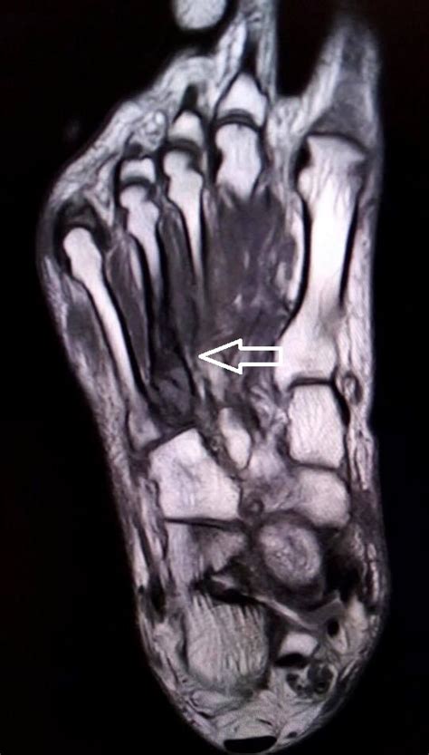 23 it can originate as a separate muscle from the ﬁbula or from the peroneus brevis or longus muscles and inserts onto the peroneal tubercle or retrotrochlear eminence of the calcaneus. Madura Foot: MRI - Sumer's Radiology Blog
