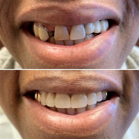 Dental Bridges Orillia ON Replacement Teeth