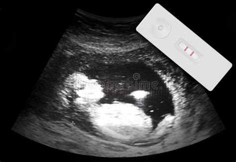 Ultrasound Film With Pregnancy Test Stock Photo Image Of Month Film