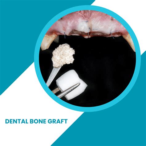 Dental Bone Graft How Much Does A Dental Bone Graft Cost