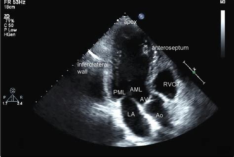 Tte Transthoracic Echocardiogram Sonosif By Sifsof California