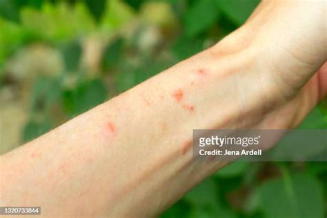 Dermatite Allergica Da Edera Velenosa Foto E Immagini Stock Getty Images