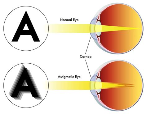 Symptoms Of Astigmatism Heffingtons