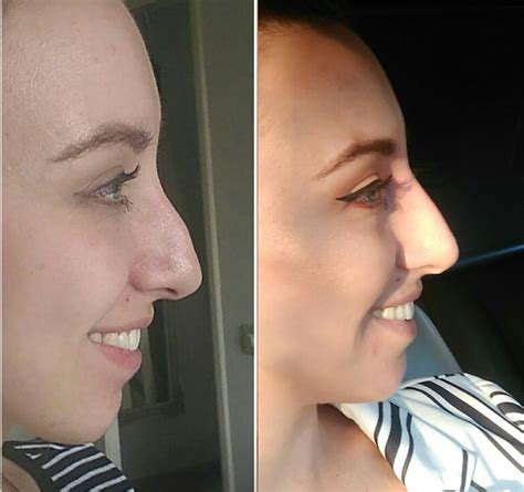 How My Non Surgical Nose Job Changed My Life BLES Magazine Beauty