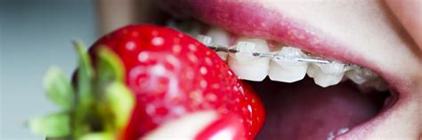 Braces Friendly Snacks Vancouver Orthodontic Specialists Pllc
