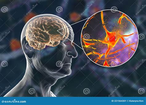 Demenz Und Alzheimer Krankheit Medizinisches Konzept 3d Illustration