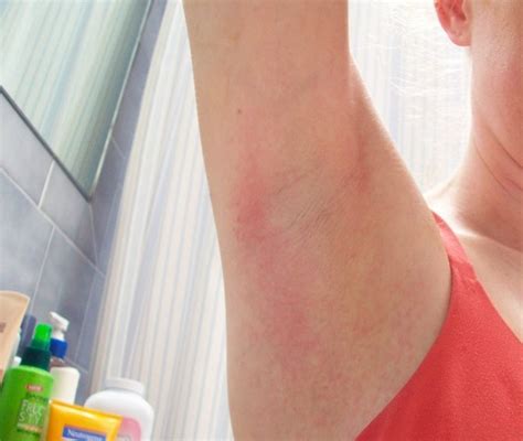 Red Itchy Rash On Arms
