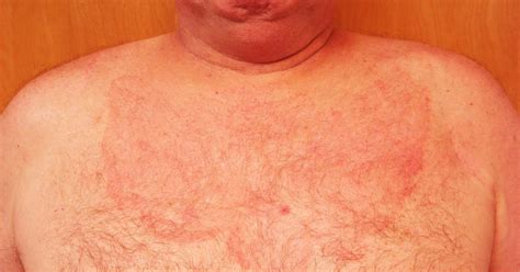 Virtual Grand Rounds In Dermatology 20 60 Yo Man With Scaly Rash