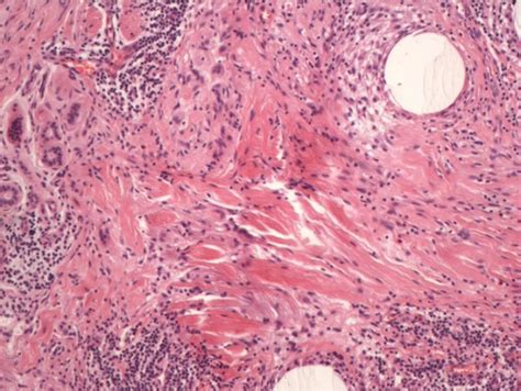 Facial Microcystic Adnexal Carcinoma — Treatment With A “jigsaw Puzzle