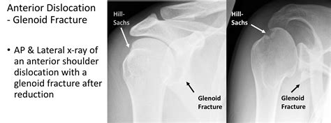 Fig 14 Traumatic Anterior Dislocation X Ray Of The Same Shoulder