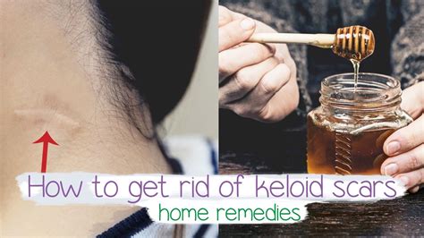 How To Get Rid Of Keloid Scars Fast Home Remedy 💚 Youtube