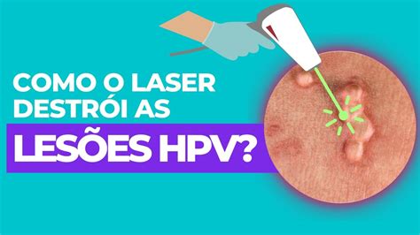 Como o laser destrói as lesões HPV YouTube