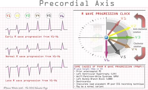 R Wave Progression Normal Chest Lead Ecg Shows An Rs Type Complex