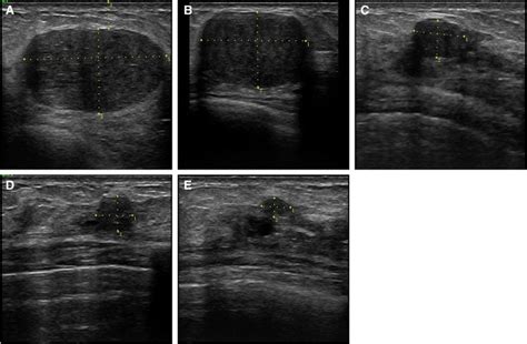 Long Term Efficacy Of Ultrasound Guided High Intensity Focused