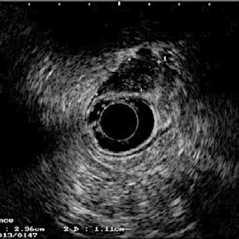 Rectal Endoscopic Ultrasonography A Sigmoid Nodule It Infiltrates